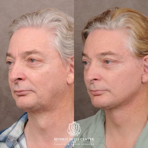 Beverly Hills Center Male Patient Before and After AuraLyft, Lateral Brow, Upper Blepharoplasty