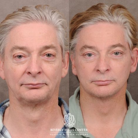 Beverly Hills Center Male Patient Before and After AuraLyft, Lateral Brow, Upper Blepharoplasty