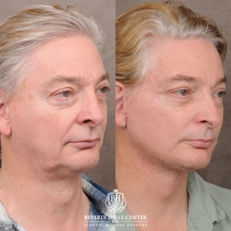 Beverly Hills Center Male Patient Before and After AuraLyft, Lateral Brow, Upper Blepharoplasty