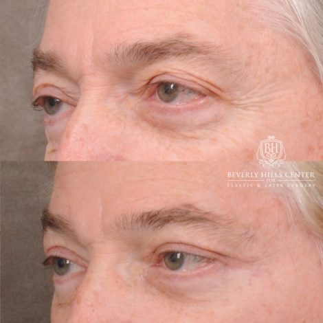 Beverly Hills Center Male Patient Before and After AuraLyft, Lateral Brow, Upper Blepharoplasty