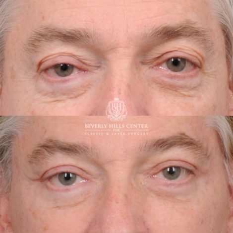 Beverly Hills Center Male Patient Before and After AuraLyft, Lateral Brow, Upper Blepharoplasty