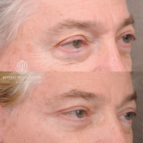 Beverly Hills Center Male Patient Before and After AuraLyft, Lateral Brow, Upper Blepharoplasty