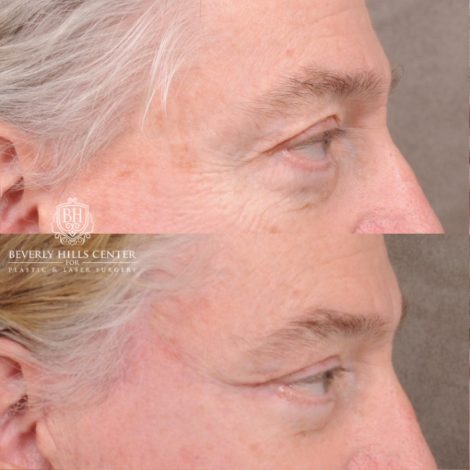 Beverly Hills Center Male Patient Before and After AuraLyft, Lateral Brow, Upper Blepharoplasty