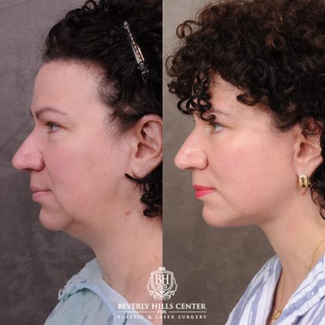 Beverly Hills Center Female Patient Before and After AuraLyft™