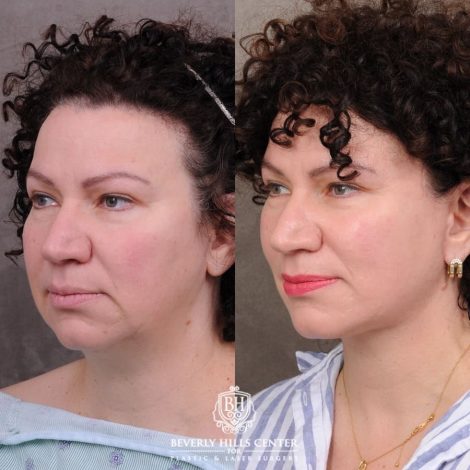 Beverly Hills Center Female Patient Before and After AuraLyft™