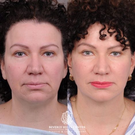 Beverly Hills Center Female Patient Before and After AuraLyft™