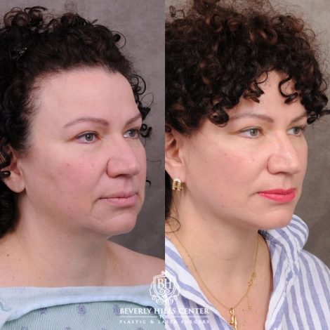 Beverly Hills Center Female Patient Before and After AuraLyft™