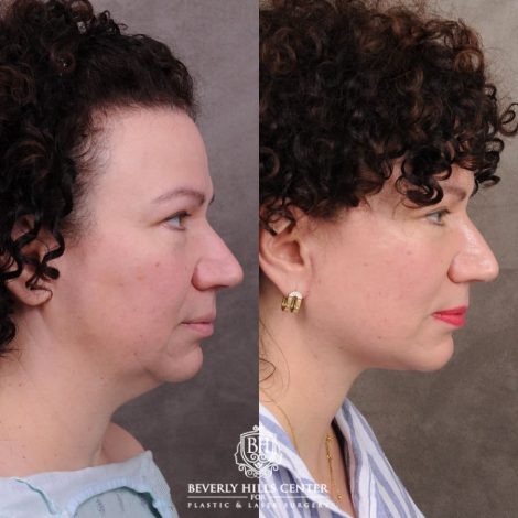 Beverly Hills Center Female Patient Before and After AuraLyft™