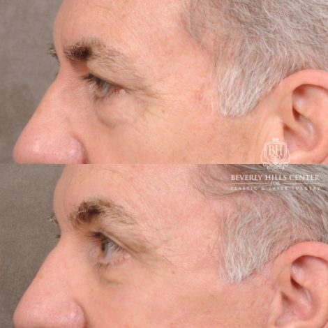 Beverly Hills Center Male Patient Before and After Auralyft™, Temporal Brow Reset, Lower Blepharoplasty