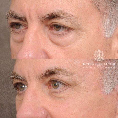 Beverly Hills Center Male Patient Before and After Auralyft™, Temporal Brow Reset, Lower Blepharoplasty