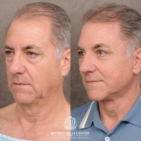 Beverly Hills Center Male Patient Before and After Auralyft™, Temporal Brow Reset, Lower Blepharoplasty