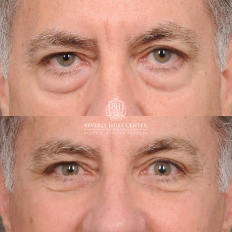 Beverly Hills Center Male Patient Before and After Auralyft™, Temporal Brow Reset, Lower Blepharoplasty