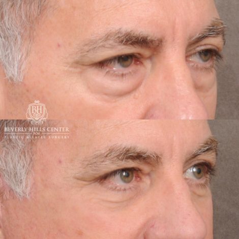 Beverly Hills Center Male Patient Before and After Auralyft™, Temporal Brow Reset, Lower Blepharoplasty