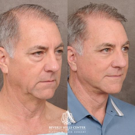 Beverly Hills Center Male Patient Before and After Auralyft™, Temporal Brow Reset, Lower Blepharoplasty