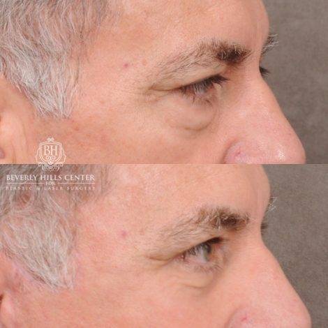 Beverly Hills Center Male Patient Before and After Auralyft™, Temporal Brow Reset, Lower Blepharoplasty