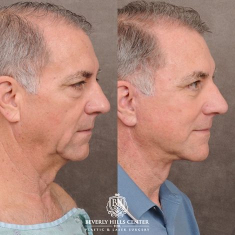 Beverly Hills Center Male Patient Before and After Auralyft™, Temporal Brow Reset, Lower Blepharoplasty
