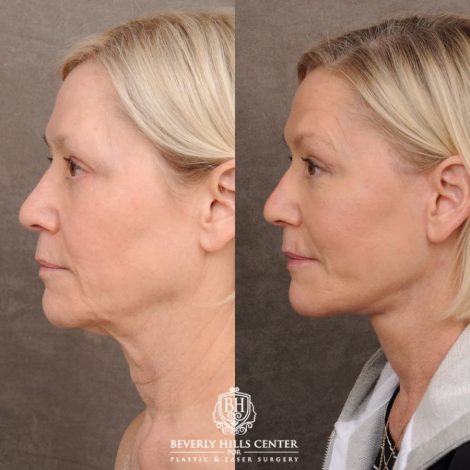 Beverly Hills Center Female Patient Before and After AuraLyft™, Temporal Brow Reset, Fat Grafting