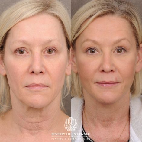 Beverly Hills Center Female Patient Before and After AuraLyft™, Temporal Brow Reset, Fat Grafting
