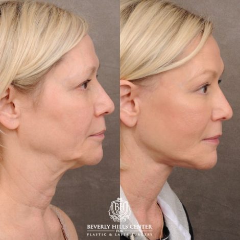 Beverly Hills Center Female Patient Before and After AuraLyft™, Temporal Brow Reset, Fat Grafting