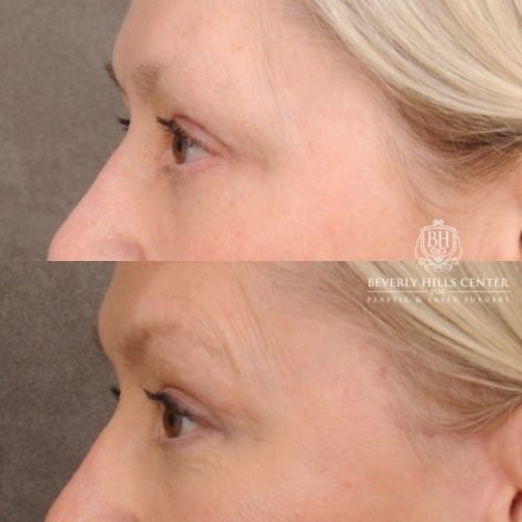 Beverly Hills Center Female Patient Before and After AuraLyft™, Temporal Brow Reset, Fat Grafting