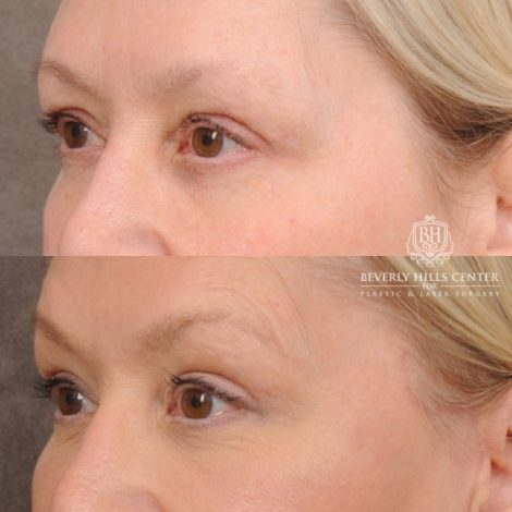 Beverly Hills Center Female Patient Before and After AuraLyft™, Temporal Brow Reset, Fat Grafting