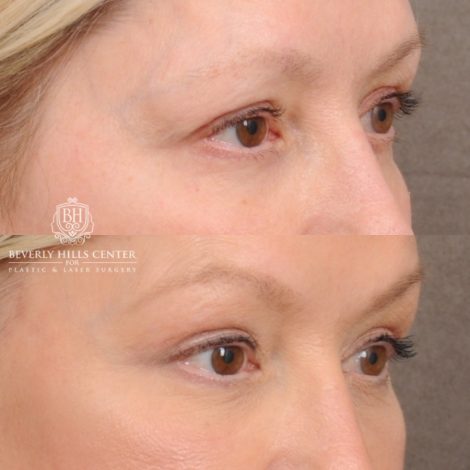 Beverly Hills Center Female Patient Before and After AuraLyft™, Temporal Brow Reset, Fat Grafting