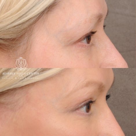 Beverly Hills Center Female Patient Before and After AuraLyft™, Temporal Brow Reset, Fat Grafting
