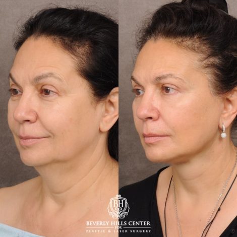 Beverly Hills Center Female Patient Before and After AuraLyft™, Temporal Brow Reset, Upper Blepharoplasty, Ptosis Repair, Cupid Lift® Corner Lift