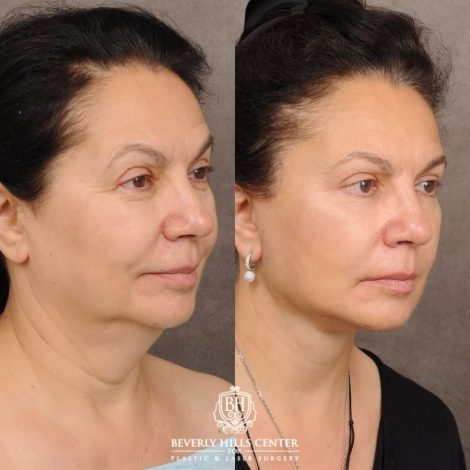Beverly Hills Center Female Patient Before and After AuraLyft™, Temporal Brow Reset, Upper Blepharoplasty, Ptosis Repair, Cupid Lift® Corner Lift