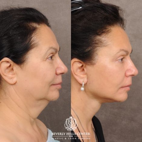 Beverly Hills Center Female Patient Before and After AuraLyft™, Temporal Brow Reset, Upper Blepharoplasty, Ptosis Repair, Cupid Lift® Corner Lift