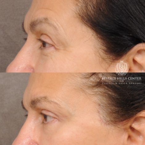 Beverly Hills Center Female Patient Before and After AuraLyft™, Temporal Brow Reset, Upper Blepharoplasty, Ptosis Repair, Cupid Lift® Corner Lift