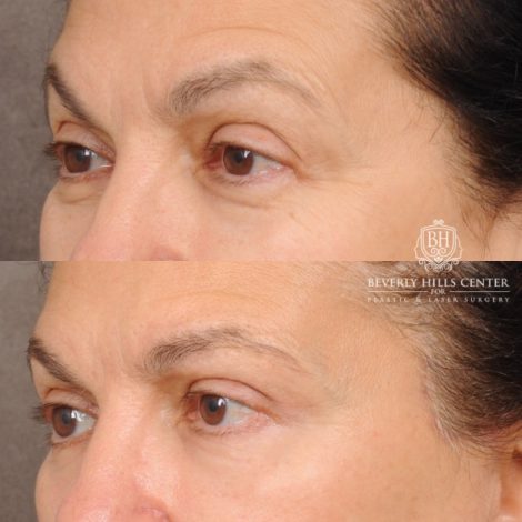Beverly Hills Center Female Patient Before and After AuraLyft™, Temporal Brow Reset, Upper Blepharoplasty, Ptosis Repair, Cupid Lift® Corner Lift