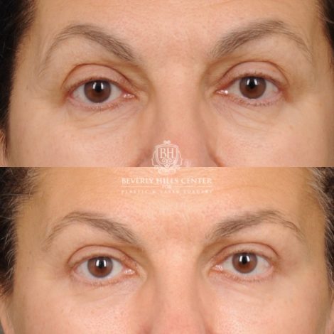 Beverly Hills Center Female Patient Before and After AuraLyft™, Temporal Brow Reset, Upper Blepharoplasty, Ptosis Repair, Cupid Lift® Corner Lift