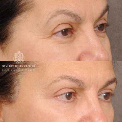 Beverly Hills Center Female Patient Before and After AuraLyft™, Temporal Brow Reset, Upper Blepharoplasty, Ptosis Repair, Cupid Lift® Corner Lift