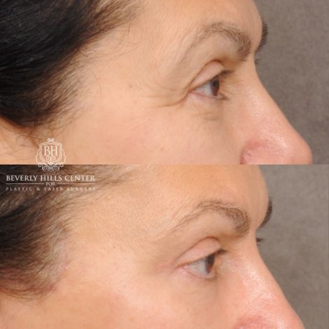 Beverly Hills Center Female Patient Before and After AuraLyft™, Temporal Brow Reset, Upper Blepharoplasty, Ptosis Repair, Cupid Lift® Corner Lift
