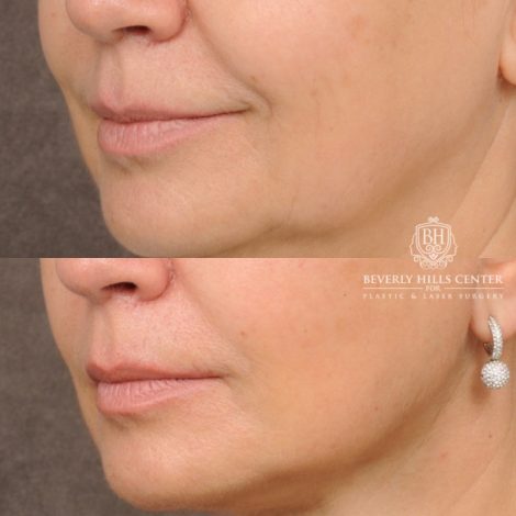 Beverly Hills Center Female Patient Before and After AuraLyft™, Temporal Brow Reset, Upper Blepharoplasty, Ptosis Repair, Cupid Lift® Corner Lift