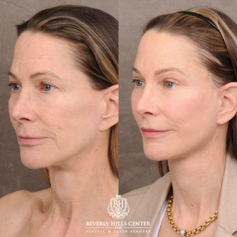 Beverly Hills Center Female Patient Before and After AuraLyft™, Temporal Brow Reset, Upper and Lower Blepharoplasty