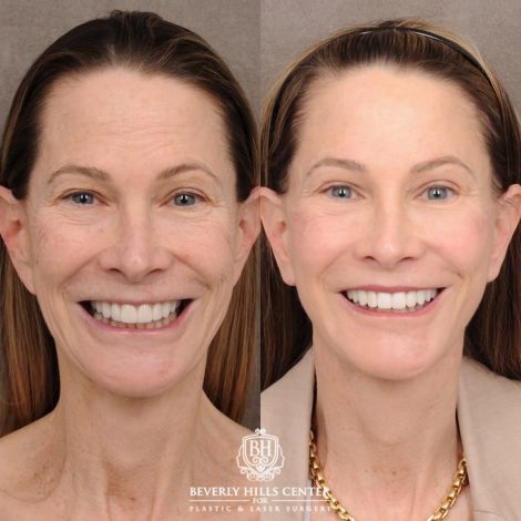 Beverly Hills Center Female Patient Before and After AuraLyft™, Temporal Brow Reset, Upper and Lower Blepharoplasty