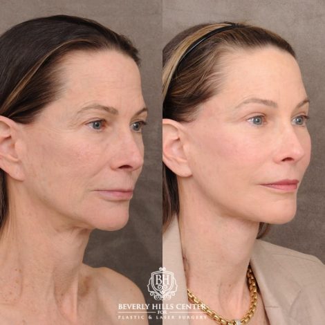 Beverly Hills Center Female Patient Before and After AuraLyft™, Temporal Brow Reset, Upper and Lower Blepharoplasty