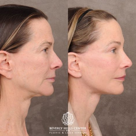 Beverly Hills Center Female Patient Before and After AuraLyft™, Temporal Brow Reset, Upper and Lower Blepharoplasty