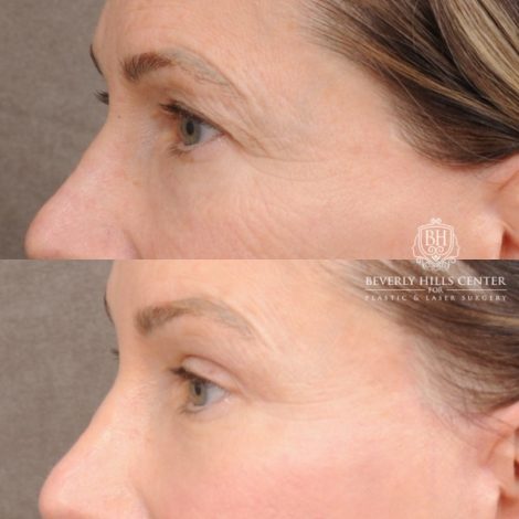 Beverly Hills Center Female Patient Before and After AuraLyft™, Temporal Brow Reset, Upper and Lower Blepharoplasty