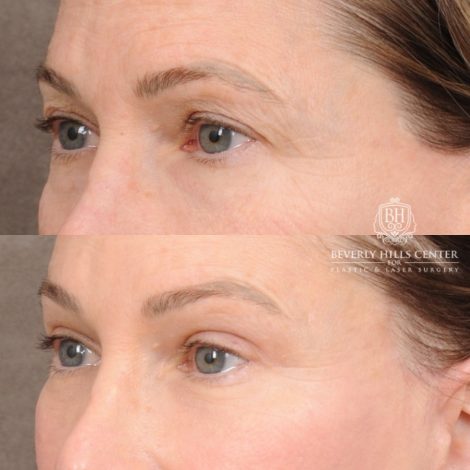 Beverly Hills Center Female Patient Before and After AuraLyft™, Temporal Brow Reset, Upper and Lower Blepharoplasty