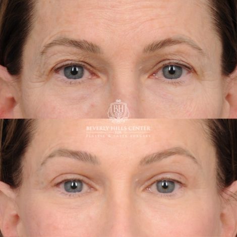 Beverly Hills Center Female Patient Before and After AuraLyft™, Temporal Brow Reset, Upper and Lower Blepharoplasty