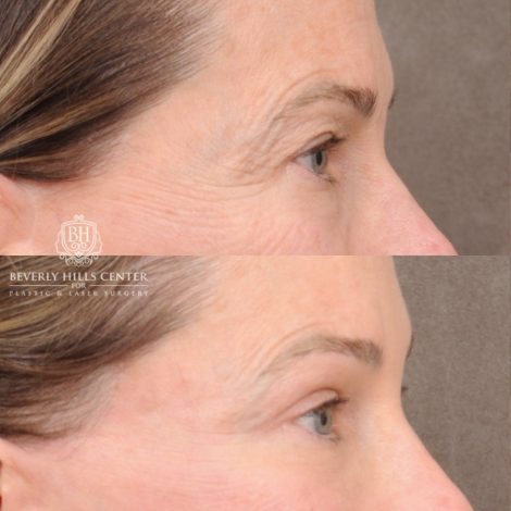 Beverly Hills Center Female Patient Before and After AuraLyft™, Temporal Brow Reset, Upper and Lower Blepharoplasty