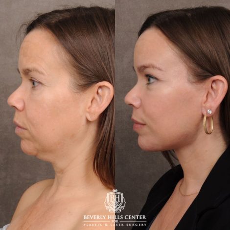 Beverly Hills Center Female Patient Before and After AuraLyft™, Temporal Brow Lift