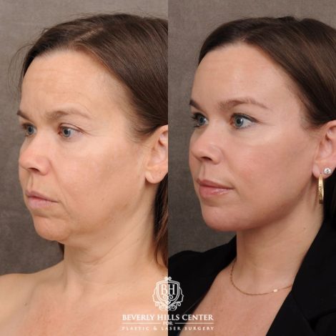 Beverly Hills Center Female Patient Before and After AuraLyft™, Temporal Brow Lift
