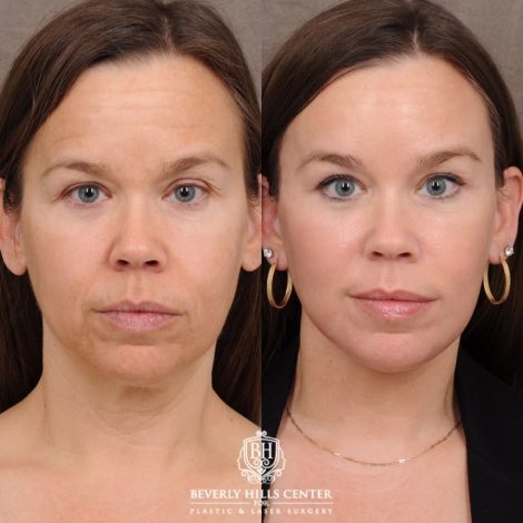 Beverly Hills Center Female Patient Before and After AuraLyft™, Temporal Brow Lift