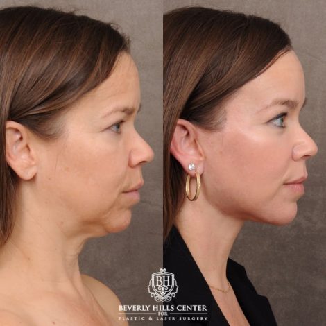 Beverly Hills Center Female Patient Before and After AuraLyft™, Temporal Brow Lift