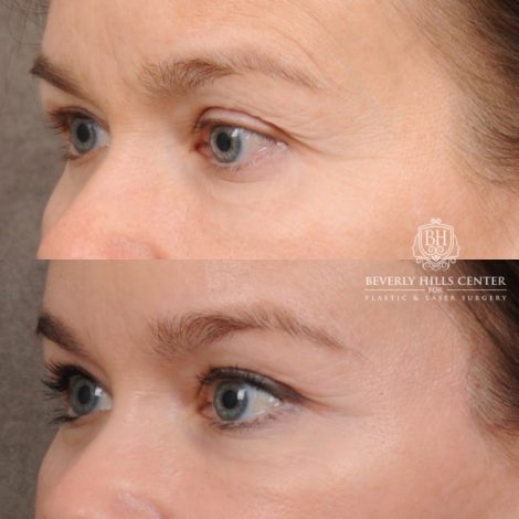 Beverly Hills Center Female Patient Before and After AuraLyft™, Temporal Brow Lift