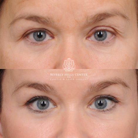 Beverly Hills Center Female Patient Before and After AuraLyft™, Temporal Brow Lift